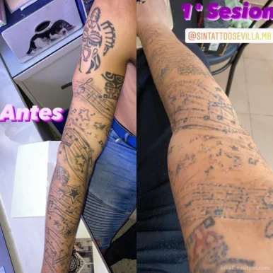 Eliminación de tatuajes sevilla, Dos Hermanas - Foto 1